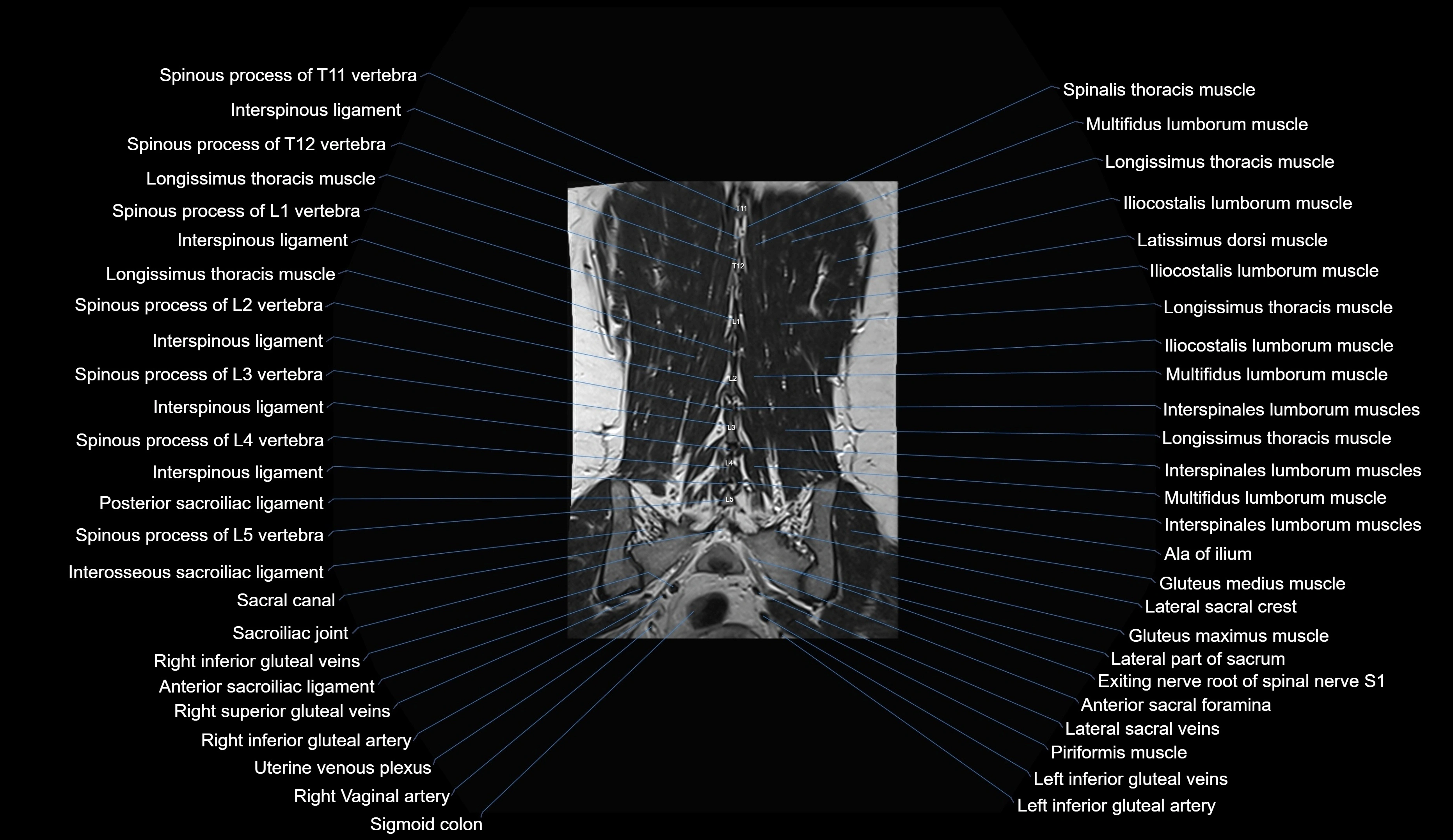 MRI lumbar spine coronal cross sectional anatomy 3T radiology  image-img-00001-00029.webp